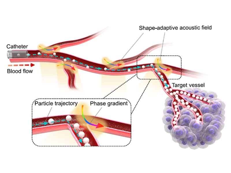 沐鸣2娱乐馬智超團隊提出基於超聲微粒操控的高選擇性血管栓塞術